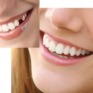 Instant Smile Multishade Temporary Tooth Repair Kit, Missing Tooth Replacement Kit, Bright Natural And Dark Shades, Patented Tooth Repair, 30 False